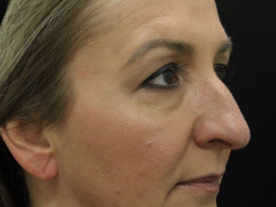 Eyelid Surgery: Case 7 - Before