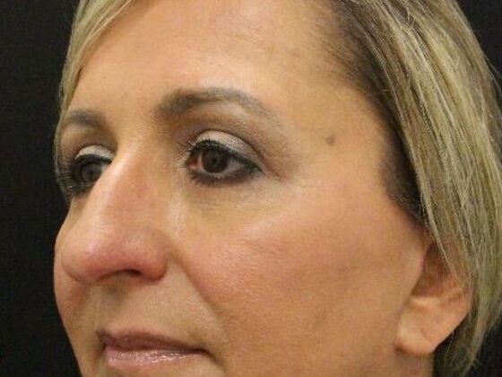 Eyelid Surgery: Case 7 - After