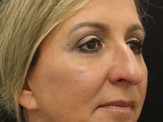 Eyelid Surgery: Case 7 - After