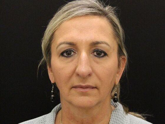 Face & Neck Lifts: Case 28 - Before