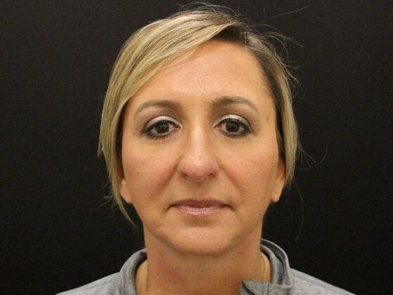 Face & Neck Lifts: Case 28 - After