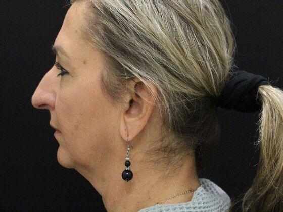 Face & Neck Lifts: Case 28 - Before