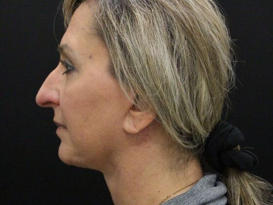 Face & Neck Lifts: Case 28 - After