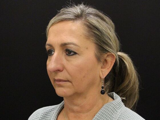 Face & Neck Lifts Case 28 - Before