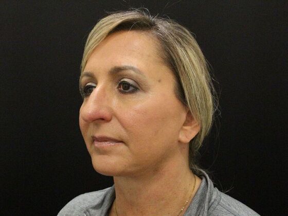 Face & Neck Lifts Case 28 - After