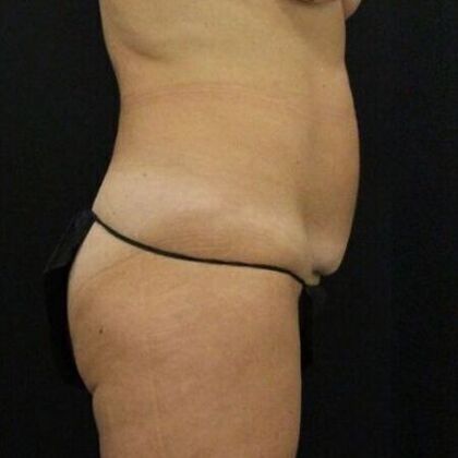 Tummy Tuck: Case 58 - Before