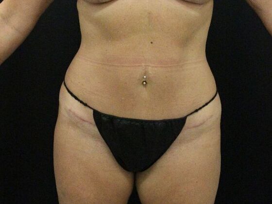 Tummy Tuck Case 58 - After