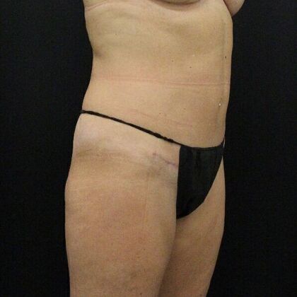 Tummy Tuck: Case 58 - After