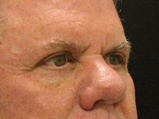 Eyelid Surgery: Case 8 - After