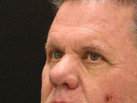 Eyelid Surgery: Case 8 - Before