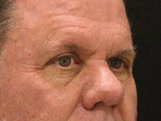 Eyelid Surgery: Case 8 - Before