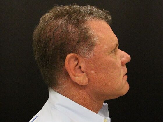 Face & Neck Lifts: Case 29 - After