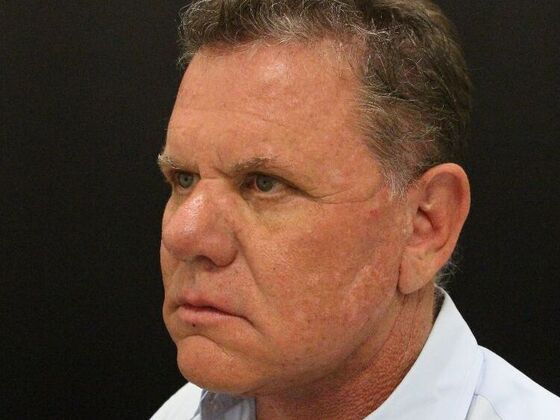 Face & Neck Lifts: Case 29 - After