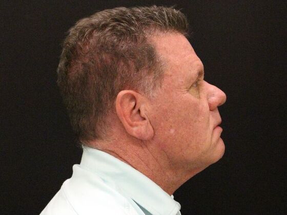 Face & Neck Lifts: Case 29 - Before