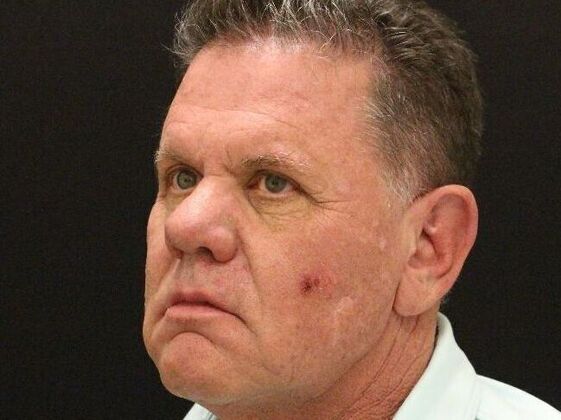 Face & Neck Lifts: Case 29 - Before