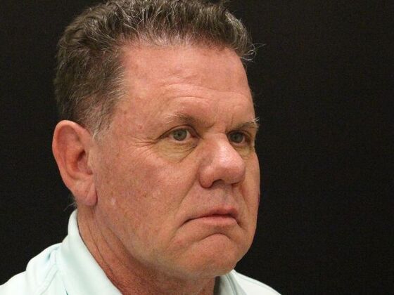 Face & Neck Lifts: Case 29 - Before