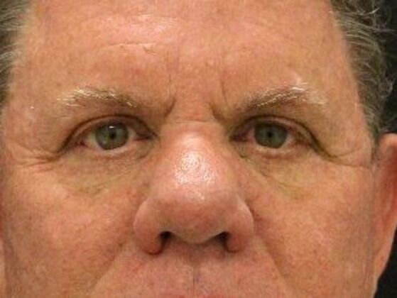 Eyelid Surgery Case 8 - After