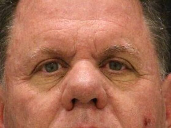 Eyelid Surgery Case 8 - Before