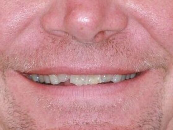 Full Mouth Rehabilitation Case 1 - Before