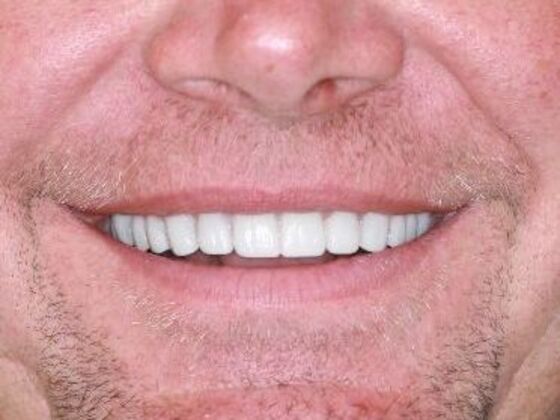 Full Mouth Rehabilitation Case 1 - After