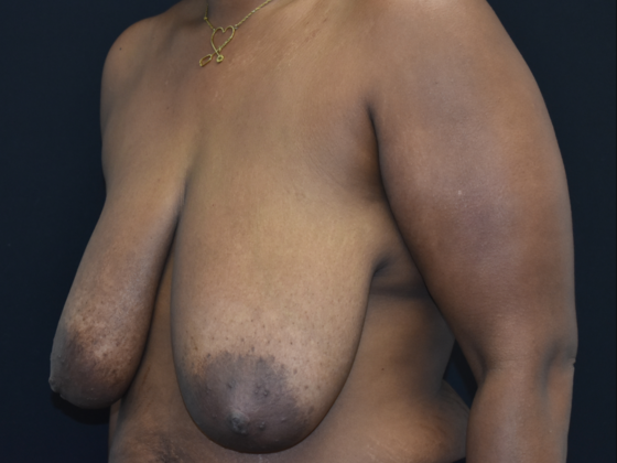 Breast Reduction: Case 7 - Before