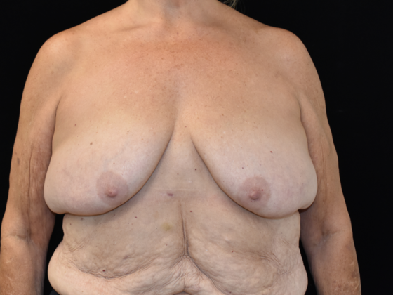 Mastopexy Case 2 - Before
