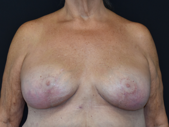 Mastopexy Case 2 - After