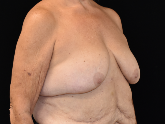 Mastopexy: Case 2 - Before