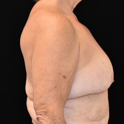 Mastopexy: Case 2 - Before