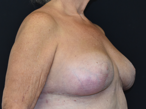 Mastopexy: Case 2 - After