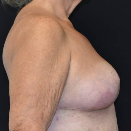 Mastopexy: Case 2 - After