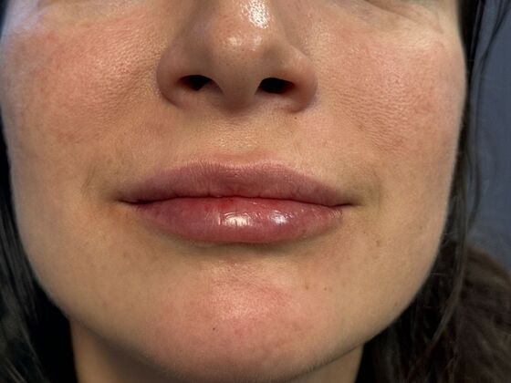 Cosmetic Injectables & Fillers*: Case 58 Lip Filler - After