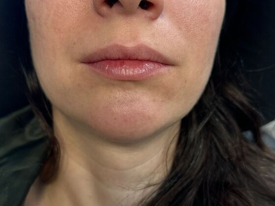 Cosmetic Injectables & Fillers*: Case 58 Lip Filler - Before