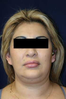 Neck Sculpting : Case 6 - Before