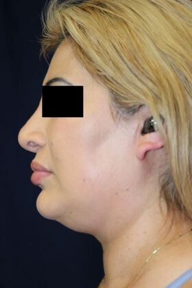 Neck Sculpting : Case 6 - Before