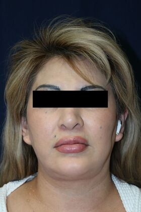 Neck Sculpting : Case 6 - After