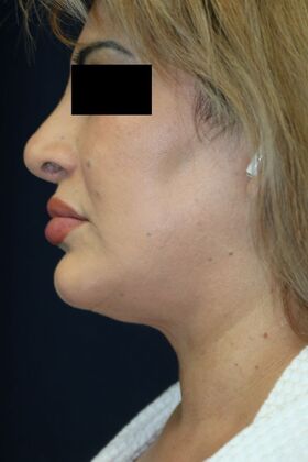 Neck Sculpting : Case 6 - After