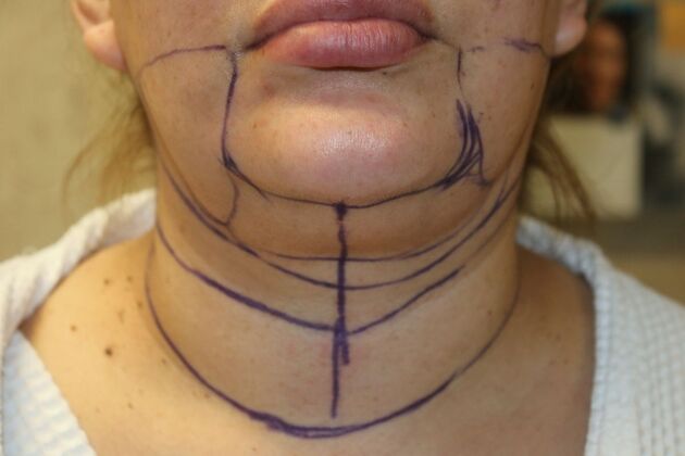 Neck Sculpting : Case 6 - Before