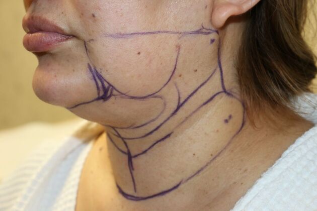 Neck Sculpting : Case 6 - Before