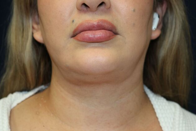 Neck Sculpting : Case 6 - After