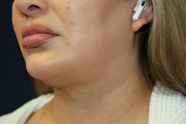 Neck Sculpting : Case 6 - After