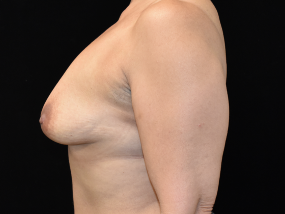 Mastopexy with Augmentation: Case 6 - Before