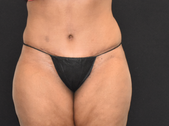 Abdominoplasty Case 10 - After