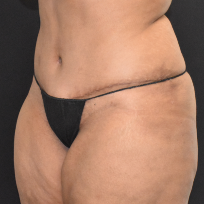 Abdominoplasty: Case 10 - After