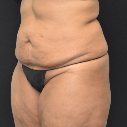 Abdominoplasty: Case 10 - Before