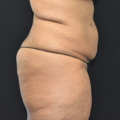 Abdominoplasty: Case 10 - Before
