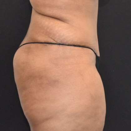 Abdominoplasty: Case 10 - After