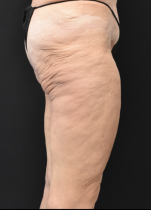 Thigh Lift: Case 1 - Before