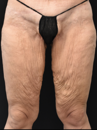 Thigh Lift Case 1 - Before