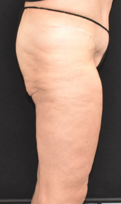 Thigh Lift: Case 1 - After